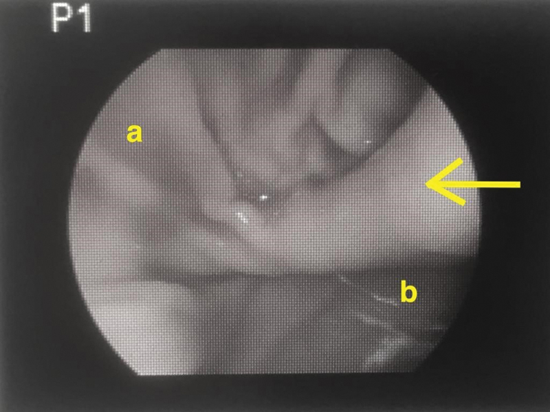 Pyloric Mucosal Diaphragm Associated with Hypertrophic Pyloric Stenosis: An Unusual Combination in a Male Neonate.