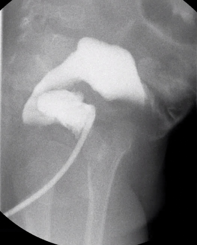 Image of the Month: Enterocolitis Following a Pull-through for Total Colonic Hirschsprung Disease in a 2-Year-Old Boy.