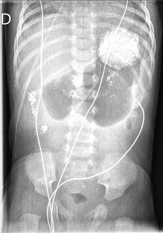 Pyloric Mucosal Diaphragm Associated with Hypertrophic Pyloric Stenosis: An Unusual Combination in a Male Neonate.