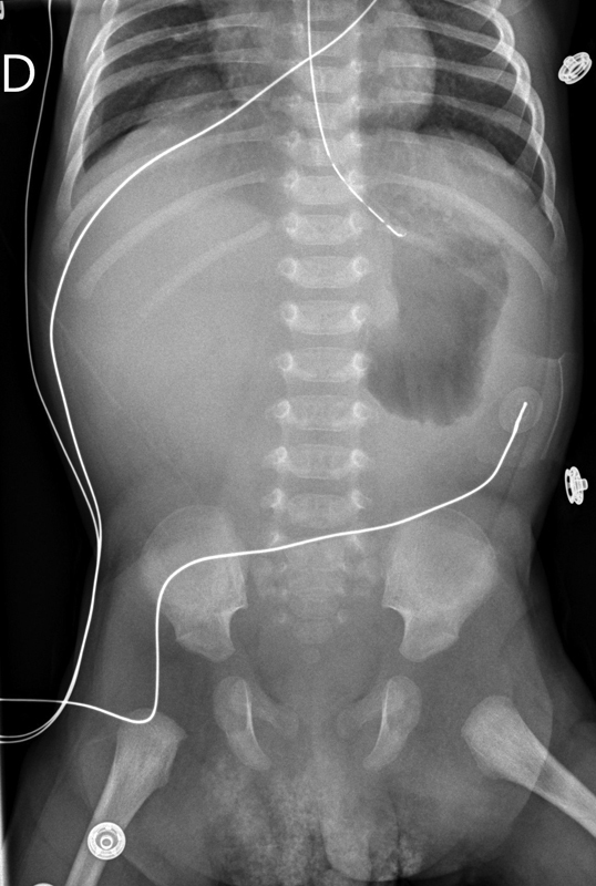 Pyloric Mucosal Diaphragm Associated with Hypertrophic Pyloric Stenosis: An Unusual Combination in a Male Neonate.