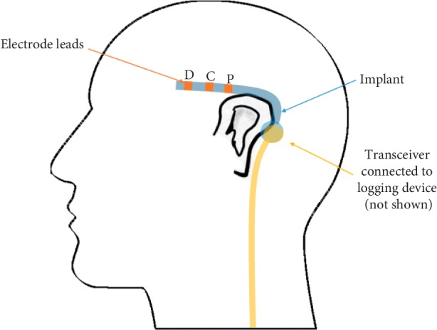 Subcutaneous EEG Monitoring Reveals AED Response and Breakthrough Seizures.