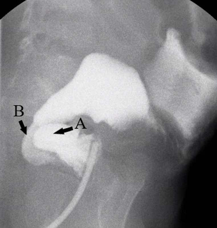 Image of the Month: Enterocolitis Following a Pull-through for Total Colonic Hirschsprung Disease in a 2-Year-Old Boy.