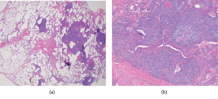 Follicular Bronchiolitis: Two Cases with Varying Clinical and Radiological Presentation.