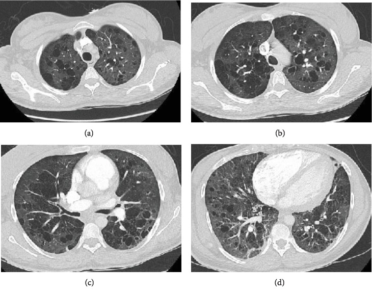 Follicular Bronchiolitis: Two Cases with Varying Clinical and Radiological Presentation.