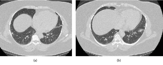 Follicular Bronchiolitis: Two Cases with Varying Clinical and Radiological Presentation.