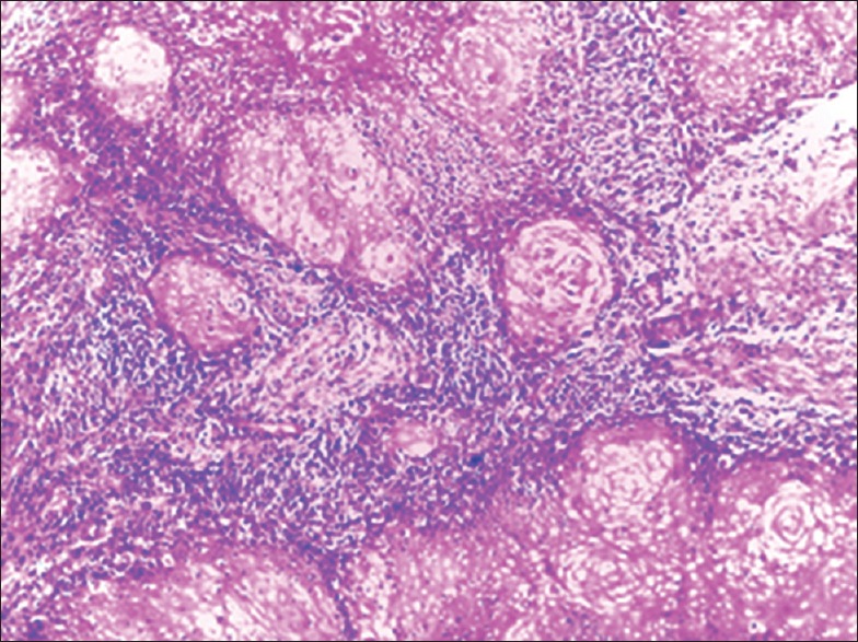 Unilateral Sinonasal Masses: Review of Clinical Presentation and Outcome in Ahmadu Bello University Teaching Hospital, Zaria, Nigeria.