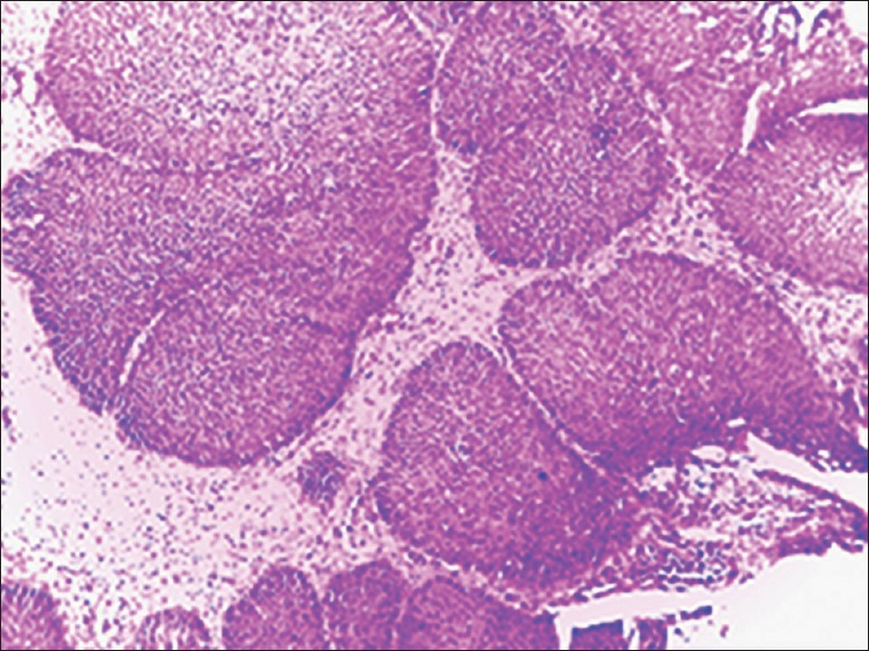 Unilateral Sinonasal Masses: Review of Clinical Presentation and Outcome in Ahmadu Bello University Teaching Hospital, Zaria, Nigeria.