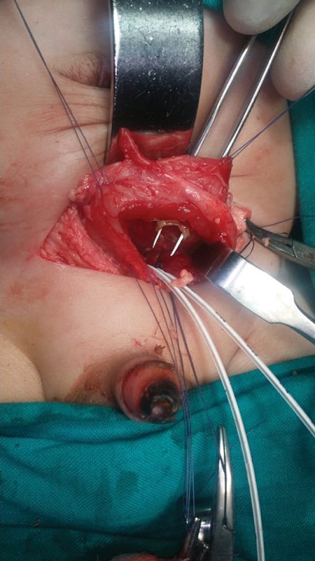 Post Circumcision Intraperitoneal Rupture of the Urinary Bladder: A Rare Complication.