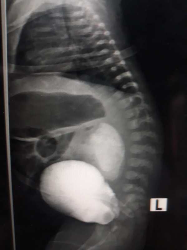 Post Circumcision Intraperitoneal Rupture of the Urinary Bladder: A Rare Complication.