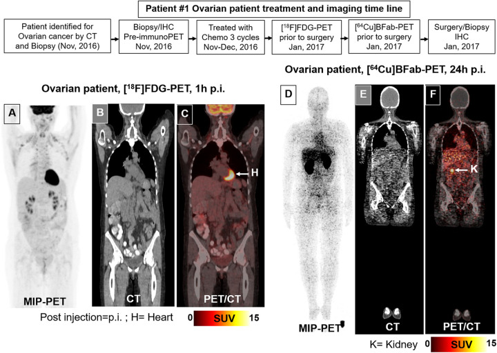 Two Patient Studies of a Companion Diagnostic Immuno-Positron Emission Tomography (PET) Tracer for Measuring Human CA6 Expression in Cancer for Antibody Drug Conjugate (ADC) Therapy.