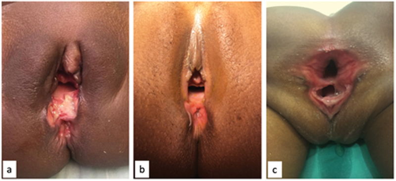 A Surgical Technique to Repair Perineal Body Disruption Secondary to Sexual Assault.