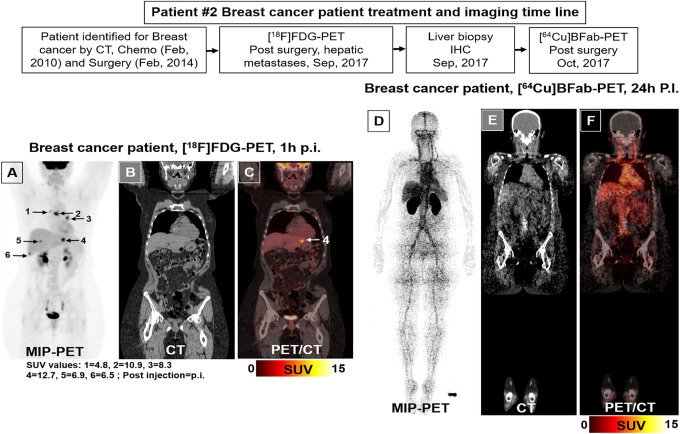 Two Patient Studies of a Companion Diagnostic Immuno-Positron Emission Tomography (PET) Tracer for Measuring Human CA6 Expression in Cancer for Antibody Drug Conjugate (ADC) Therapy.