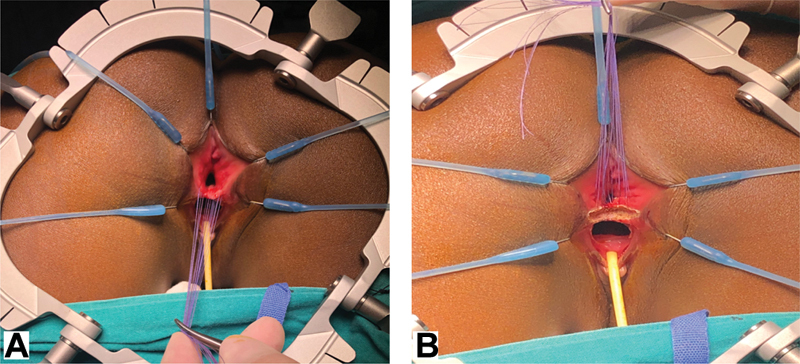 A Surgical Technique to Repair Perineal Body Disruption Secondary to Sexual Assault.