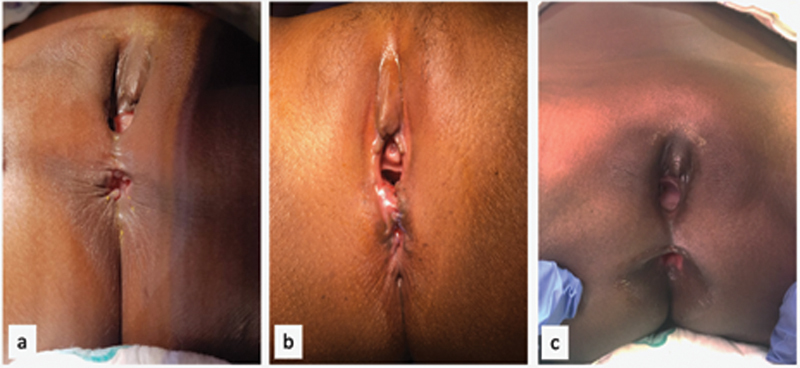 A Surgical Technique to Repair Perineal Body Disruption Secondary to Sexual Assault.