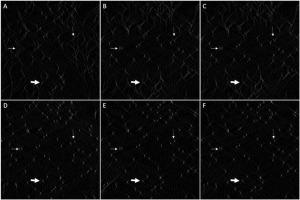 Improvements on marker-free images alignment for electron tomography