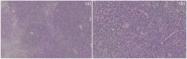 Doege-Potter Syndrome and Hypoglycemia associated with Solitary Fibrous Tumor of the Pleura: Two Case Reports.