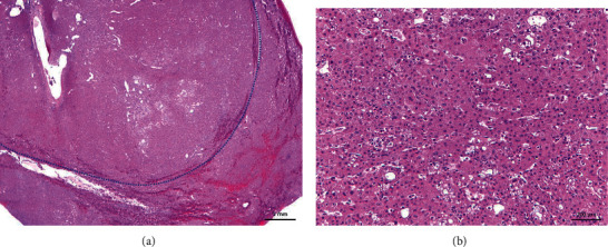 Hepatocellular Carcinoma in a 24-Year-Old Female with Beckwith-Wiedemann Syndrome: A Case Report and Review of the Literature.