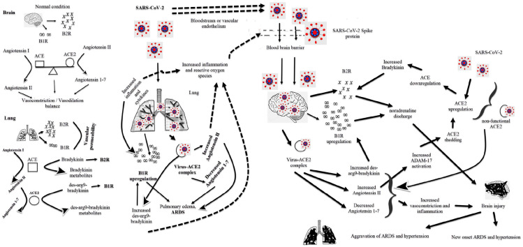 Central involvement of SARS-CoV-2 may aggravate ARDS and hypertension.