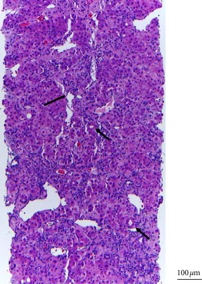 Hepatocellular Carcinoma in a 24-Year-Old Female with Beckwith-Wiedemann Syndrome: A Case Report and Review of the Literature.