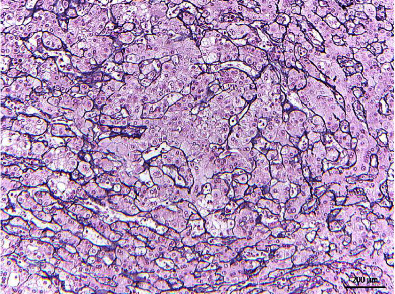 Hepatocellular Carcinoma in a 24-Year-Old Female with Beckwith-Wiedemann Syndrome: A Case Report and Review of the Literature.