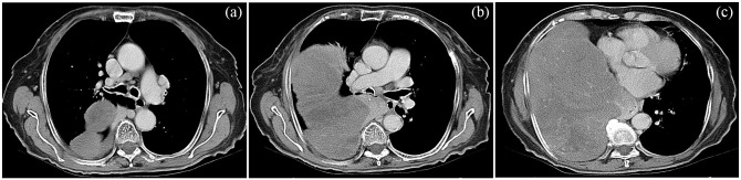 Doege-Potter Syndrome and Hypoglycemia associated with Solitary Fibrous Tumor of the Pleura: Two Case Reports.