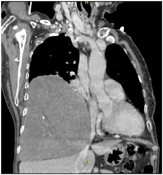 Doege-Potter Syndrome and Hypoglycemia associated with Solitary Fibrous Tumor of the Pleura: Two Case Reports.