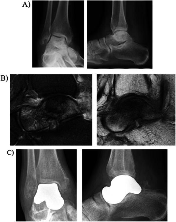 Clinical applications of custom 3D printed implants in complex lower extremity reconstruction.