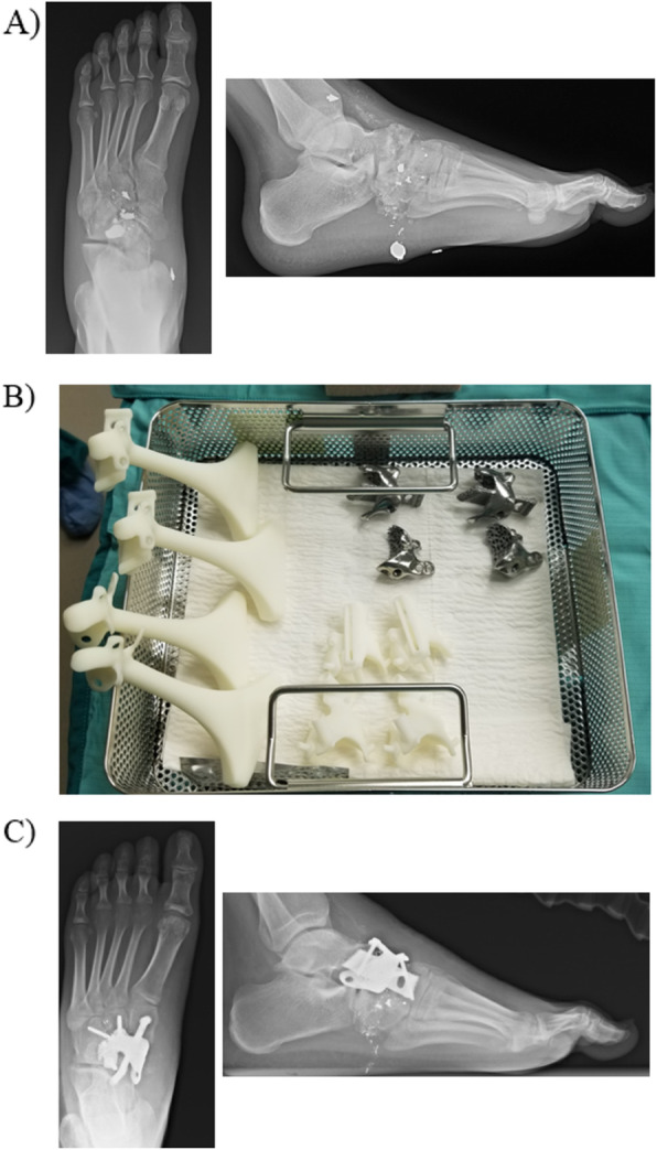 Clinical applications of custom 3D printed implants in complex lower extremity reconstruction.