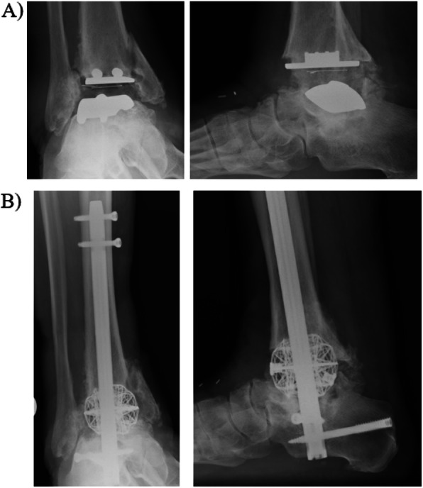 Clinical applications of custom 3D printed implants in complex lower extremity reconstruction.