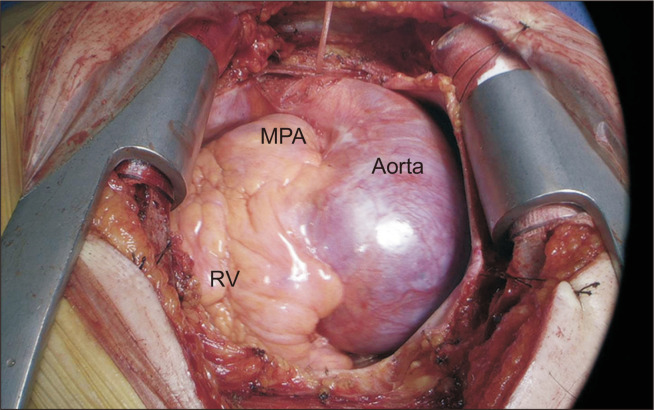 Acute Type A Aortic Dissection in a Patient with Situs Inversus Totalis.