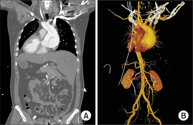 Acute Type A Aortic Dissection in a Patient with Situs Inversus Totalis.