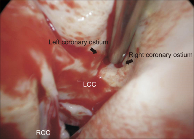 Acute Type A Aortic Dissection in a Patient with Situs Inversus Totalis.