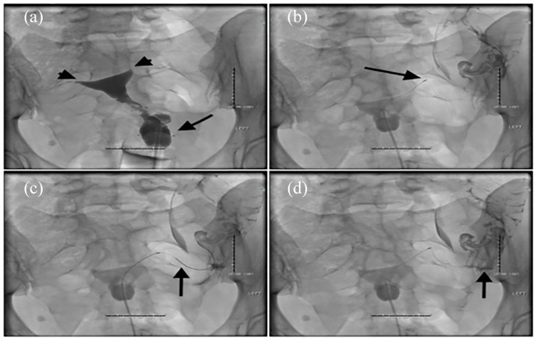 Conception rates after fluoroscopy-guided fallopian tubal cannulation: an alternative to <i>in vitro</i> fertilization for patients with tubal occlusion.