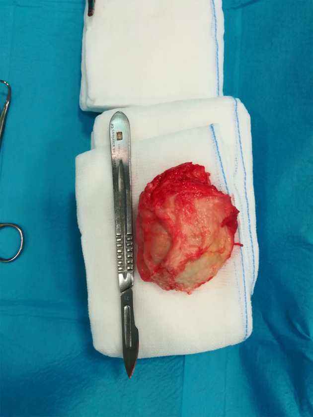 Subcutaneous neurofibroma as a cause of lameness in a warmblood horse: Neurofibroma in a horse.