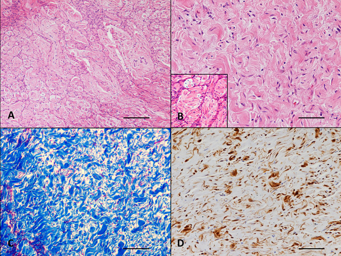 Subcutaneous neurofibroma as a cause of lameness in a warmblood horse: Neurofibroma in a horse.