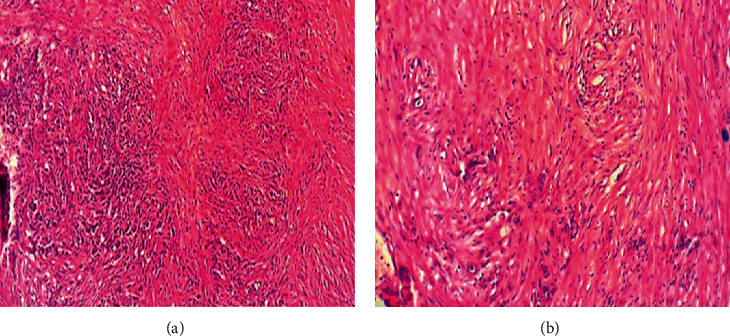 Management of the Uncommon Bladder Cancers: A Single-Center Experience over 10 Years.