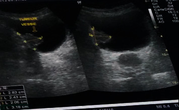 Management of the Uncommon Bladder Cancers: A Single-Center Experience over 10 Years.