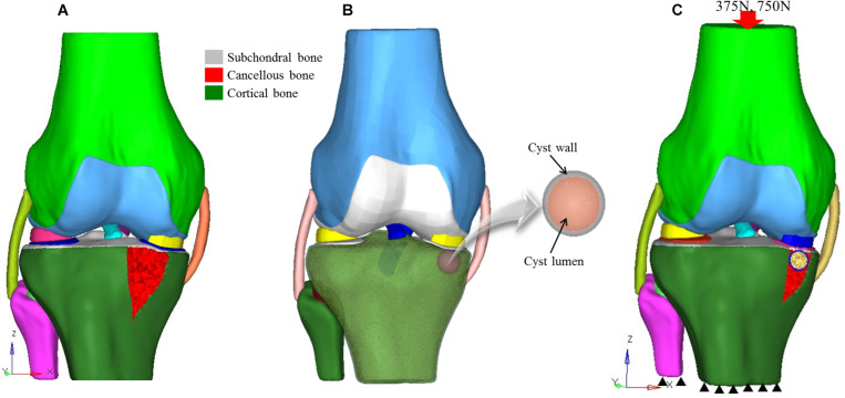 Multiple Subchondral Bone Cysts Cause Deterioration of Articular Cartilage in Medial OA of Knee: A 3D Simulation Study.