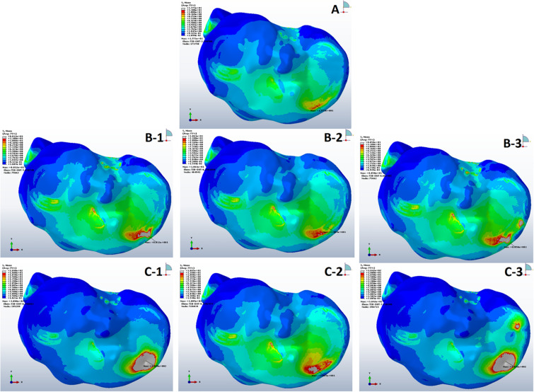 Multiple Subchondral Bone Cysts Cause Deterioration of Articular Cartilage in Medial OA of Knee: A 3D Simulation Study.