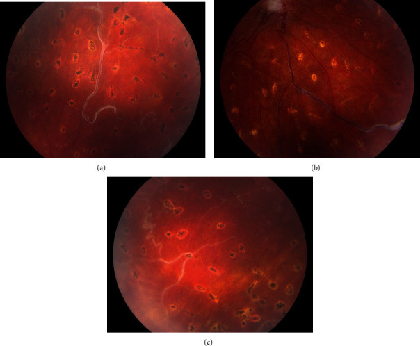 Vitreous Hemorrhage as Presenting Sign of Retinal Arteriovenous Malformation.