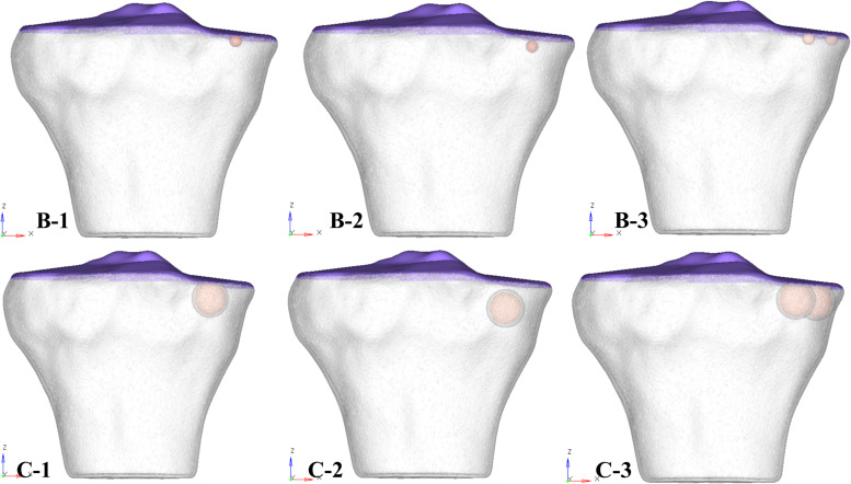 Multiple Subchondral Bone Cysts Cause Deterioration of Articular Cartilage in Medial OA of Knee: A 3D Simulation Study.