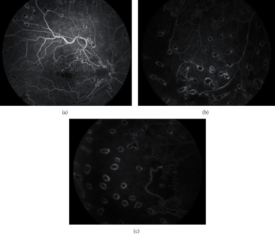 Vitreous Hemorrhage as Presenting Sign of Retinal Arteriovenous Malformation.