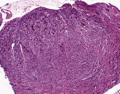 Spindle Cell Melanoma Presenting as an Ulcer in a Black Diabetic.