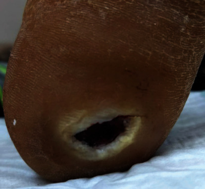 Spindle Cell Melanoma Presenting as an Ulcer in a Black Diabetic.