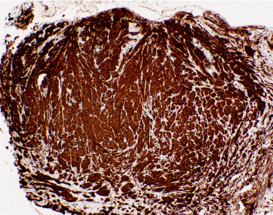 Spindle Cell Melanoma Presenting as an Ulcer in a Black Diabetic.