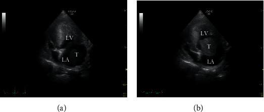 The Rare Occurrence of a Left Atrial Thrombus in a Dog.