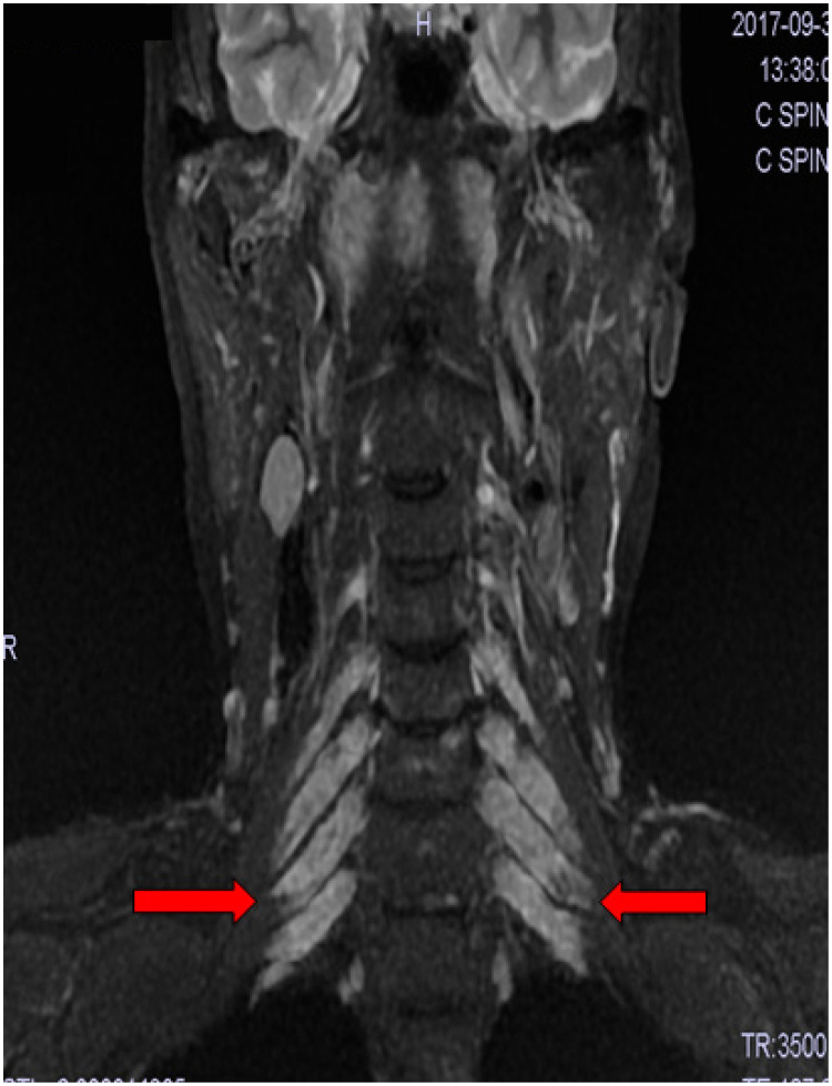 Enlarged Brachial Plexus Nerve Found During Ultrasound-Guided Peripheral Nerve Block Diagnosed as Charcot-Marie-Tooth Disease: A Case Report.