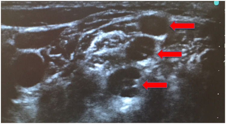 Enlarged Brachial Plexus Nerve Found During Ultrasound-Guided Peripheral Nerve Block Diagnosed as Charcot-Marie-Tooth Disease: A Case Report.