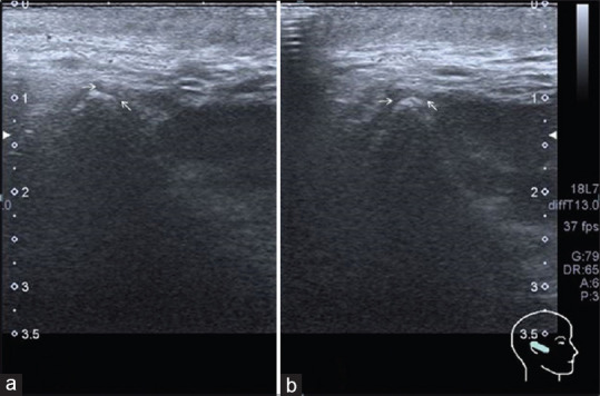 The evaluation of agreement between high-frequency ultrasonography and research diagnostic criteria for the diagnosis of temporomandibular joint internal derangements.