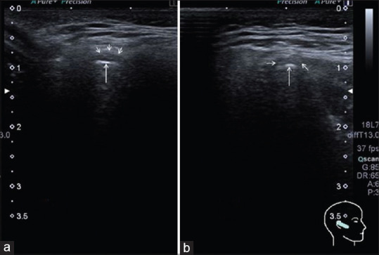 The evaluation of agreement between high-frequency ultrasonography and research diagnostic criteria for the diagnosis of temporomandibular joint internal derangements.